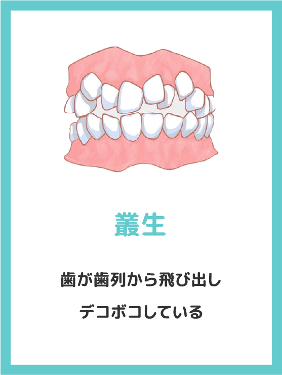 叢生・歯が歯列から飛び出しデコボコしている